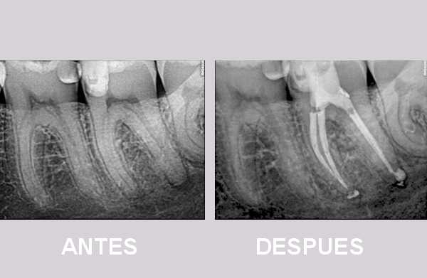 Endodoncia